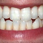 Clasificación de la dentadura